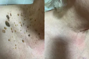 🐝 Bee Venom Mole and Wart Treatment Cream (AAD Recommended) photo review