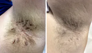 🐝 Bee Venom Mole and Wart Treatment Cream (AAD Recommended) photo review