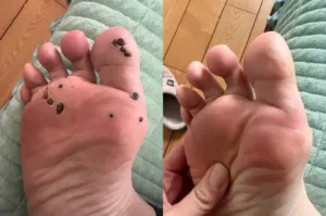 🐝 Bee Venom Mole and Wart Treatment Cream (AAD Recommended) photo review