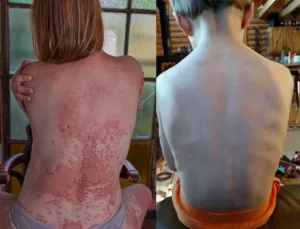 🐝 Bee Venom Mole and Wart Treatment Cream (AAD Recommended) photo review
