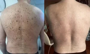 🐝 Bee Venom Mole and Wart Treatment Cream (AAD Recommended) photo review