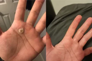🐝 Bee Venom Mole and Wart Treatment Cream (AAD Recommended) photo review