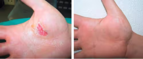 🩸 Diabetic Wounds Treatment Cream photo review