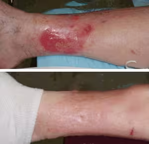 🩸 Diabetic Wounds Treatment Cream photo review